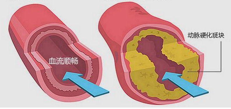 动脉硬化检测及相关结果报告解读
