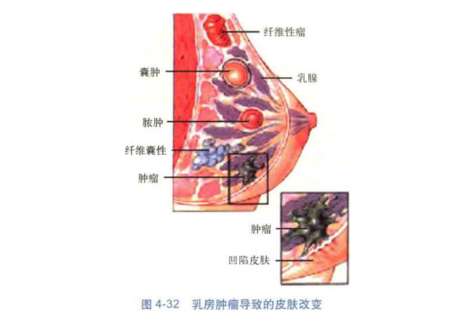 乳腺癌的症状都哪些