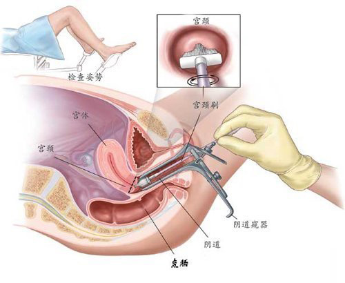 宫颈病理涂片检查