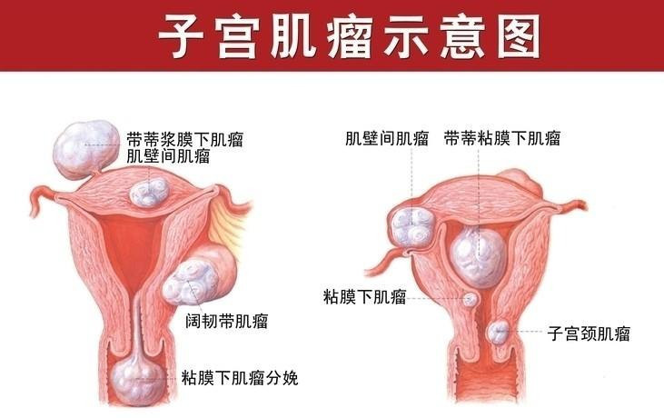 子宫肌瘤示意图