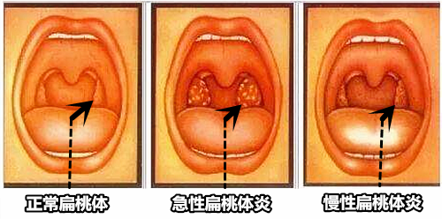 扁桃体的正常图片图片